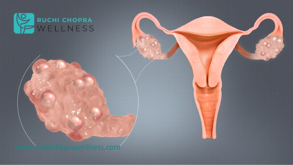 Struggling with pcos gaining weight like crazy is a common challenge.